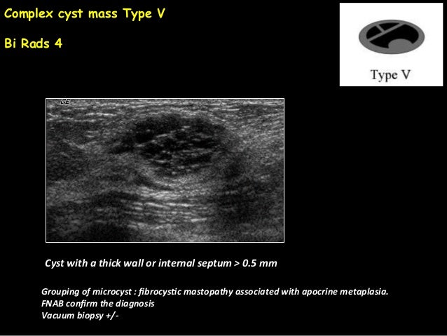 diagnostics breast biopsy complex cyst Gay p0rno org